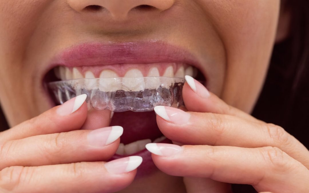 How To Straighten Your Teeth? Braces and Invisalign Explained