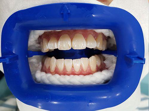 TeethWhitening1 before
