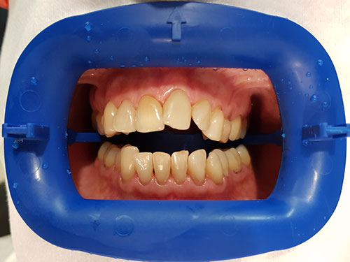 TeethWhitening2 before