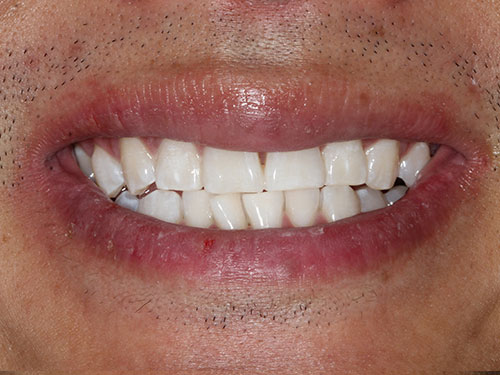 TeethWhitening3 after