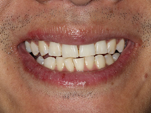 TeethWhitening3 before