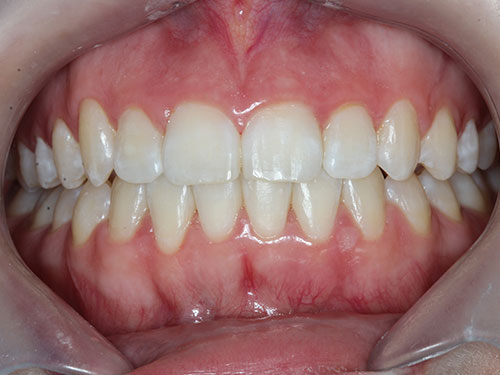 ortho5 after
