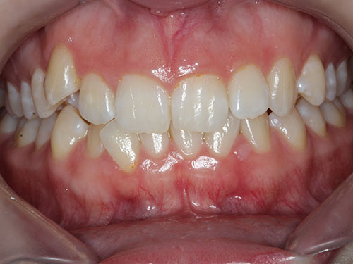 ortho5 before