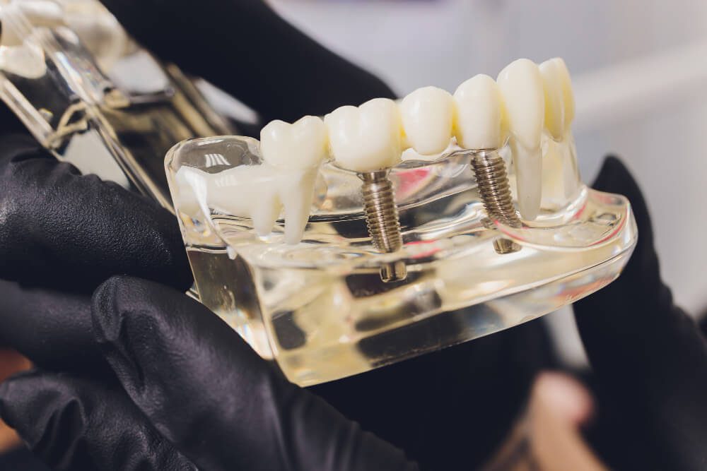 Dental Implant Bone Graft — What Is It And When Is It Needed?