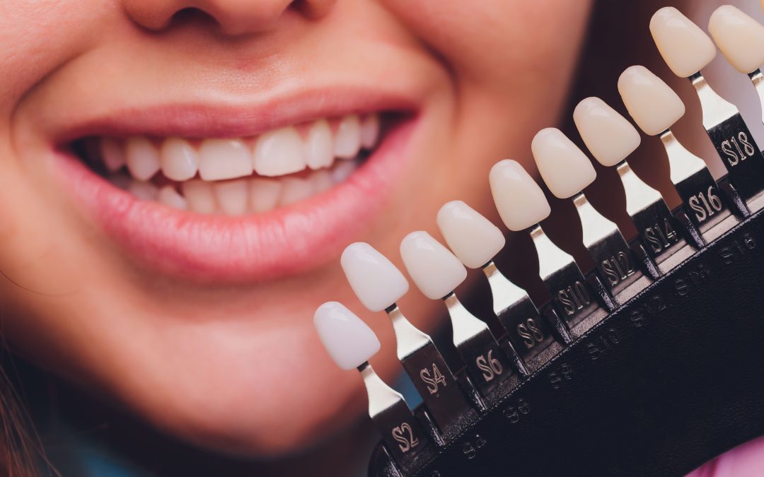 Dental Veneers: Procedure, Benefits, Types, and Aftercare
