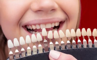 Porcelain Veneers vs Composite Veneers: Pros, Cons & Differences