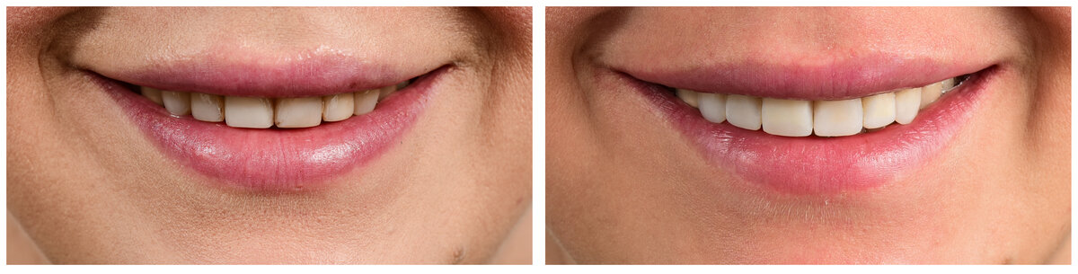 composite veneers before and after