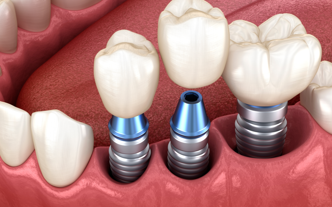 dental implants cost