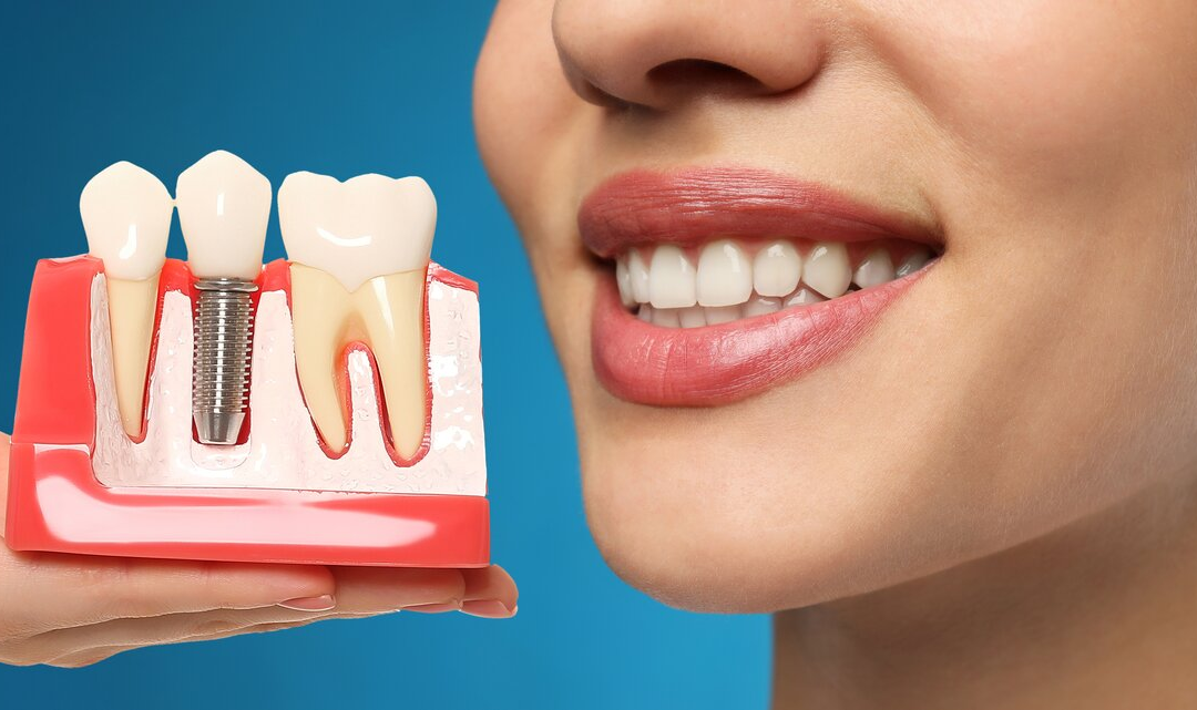 Do Dental Implants Feel Natural? A Comprehensive Guide