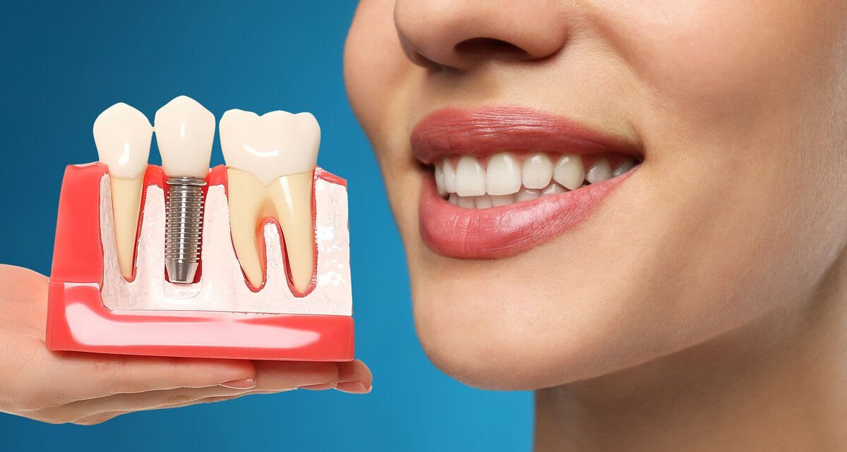 do dental implants feel natural burwood