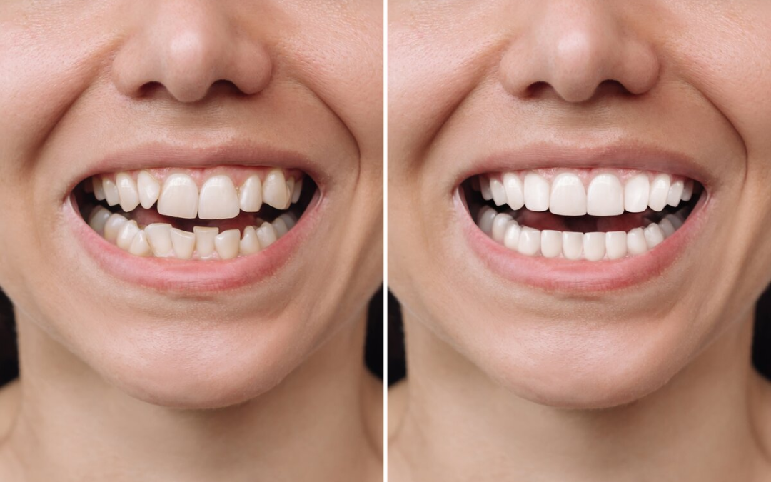 Effective Hydrogen Peroxide Teeth Whitening: A Guide