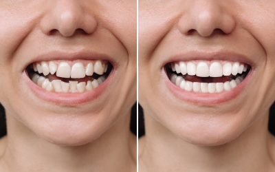 Effective Hydrogen Peroxide Teeth Whitening: A Guide