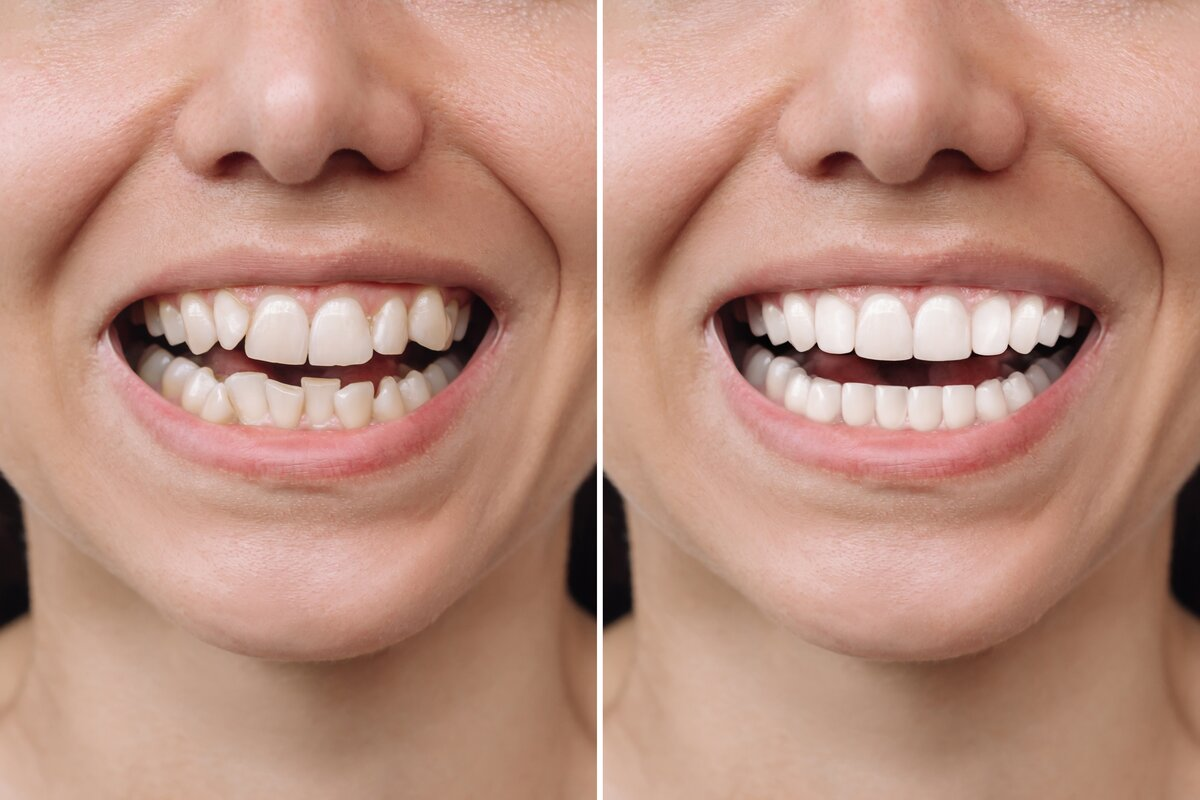 effective-hydrogen-peroxide-teeth-whitening-a-guide