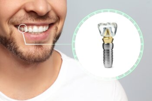 full mouth dental implants burwood