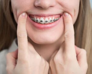 Invisalign For Crowded Teeth cost