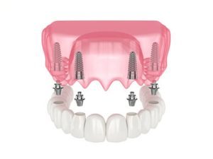 all 4 dental implants cost illustration