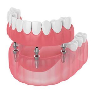 all on 4 dental implants illustration