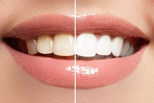Cost Of Teeth Whitening Australia before after burwood