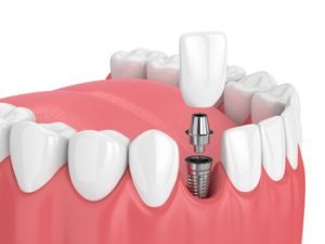 Single Tooth Implant Cost Australia guide burwood
