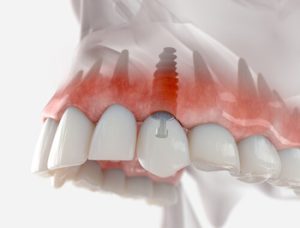 dental implant thailand illustration burwood