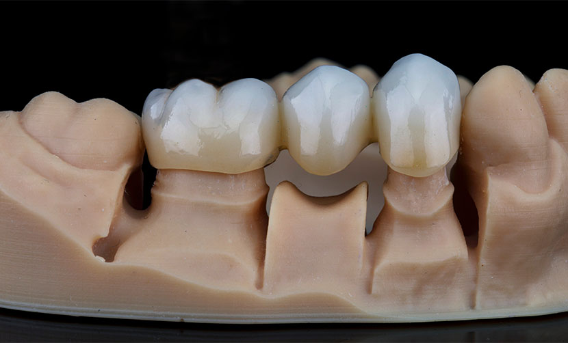 dental crowns made in the lab