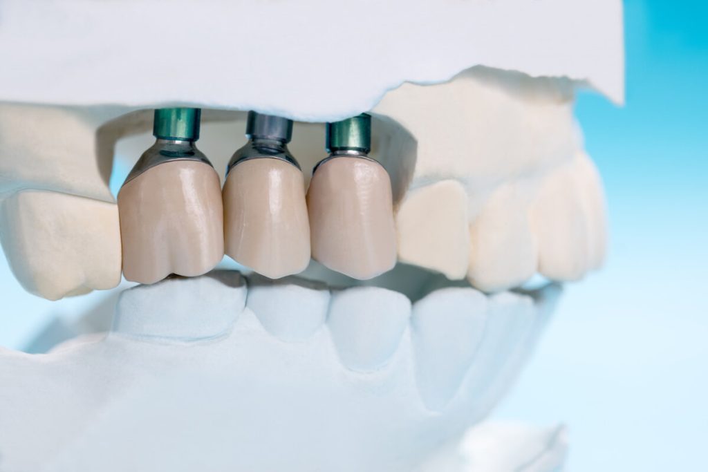 are dental implants safe