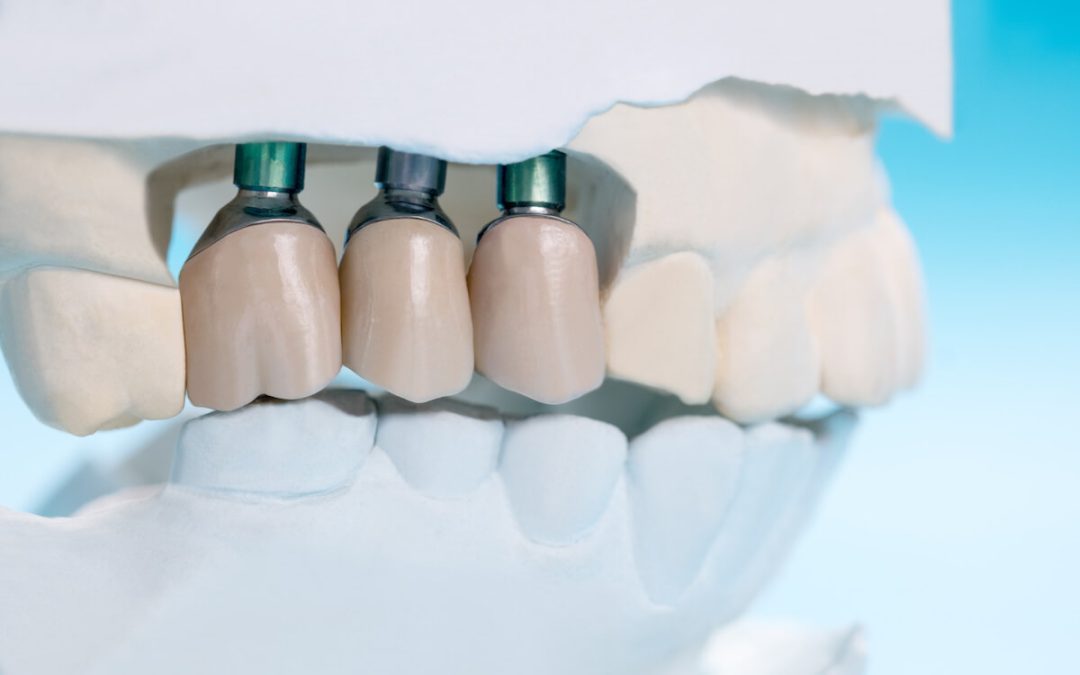 Are Dental Implants Safe? We Have All The Answers You Need