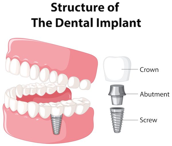 Infographic of human in structure of the dental implant