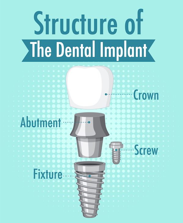 Infographic of human in structure of the dental implant