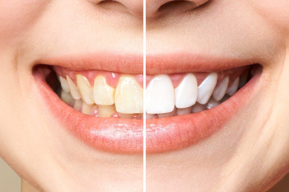 the benefits of teeth whitening