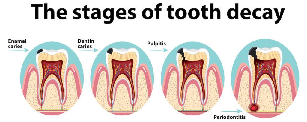 causes of dental cavities