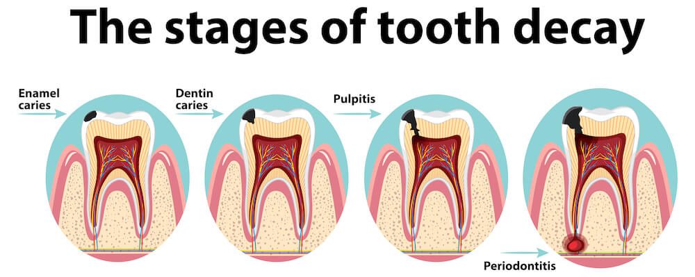 the role of carbohydrates in tooth decay