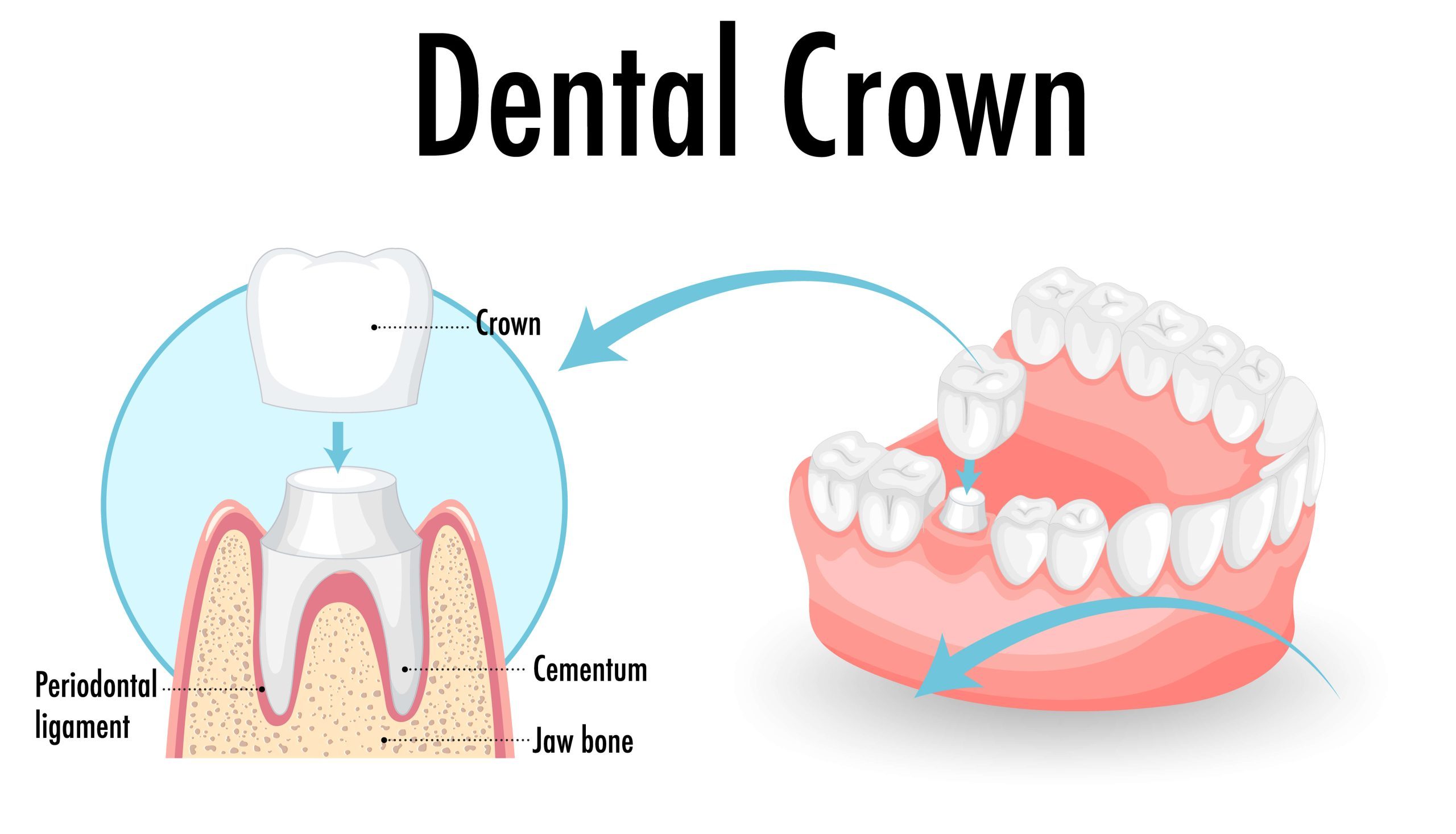 Types of Dental Crowns scaled