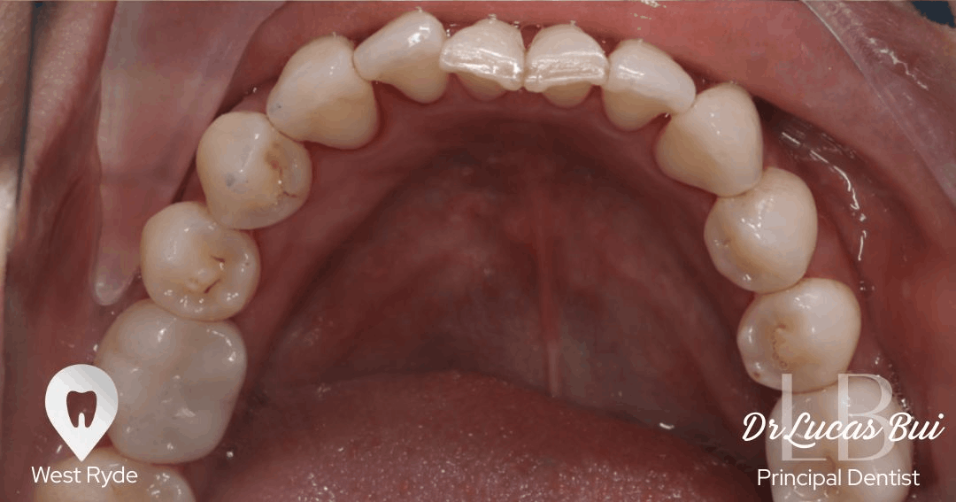 implant after