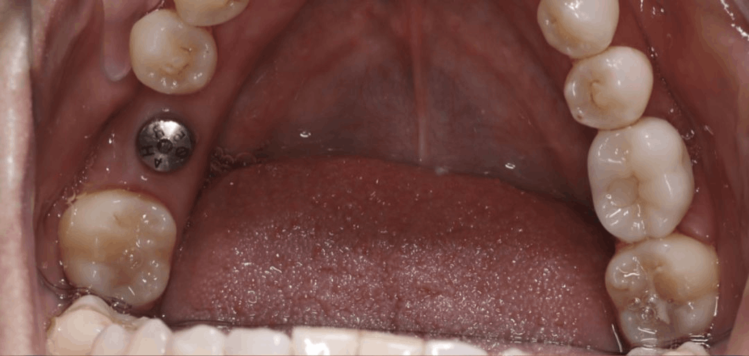 implant after