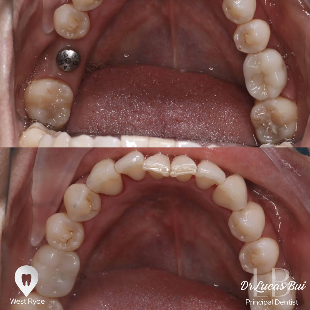 implant