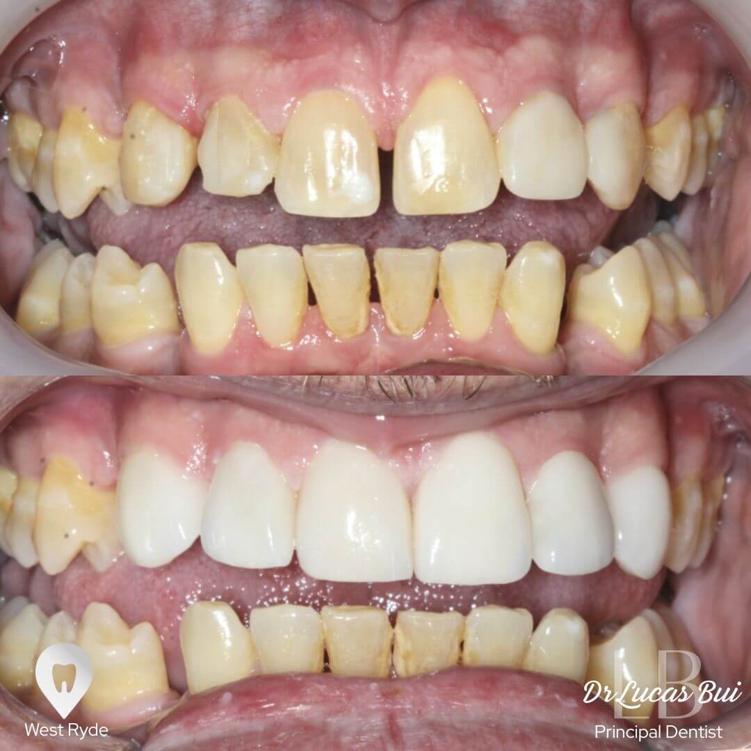 veneers