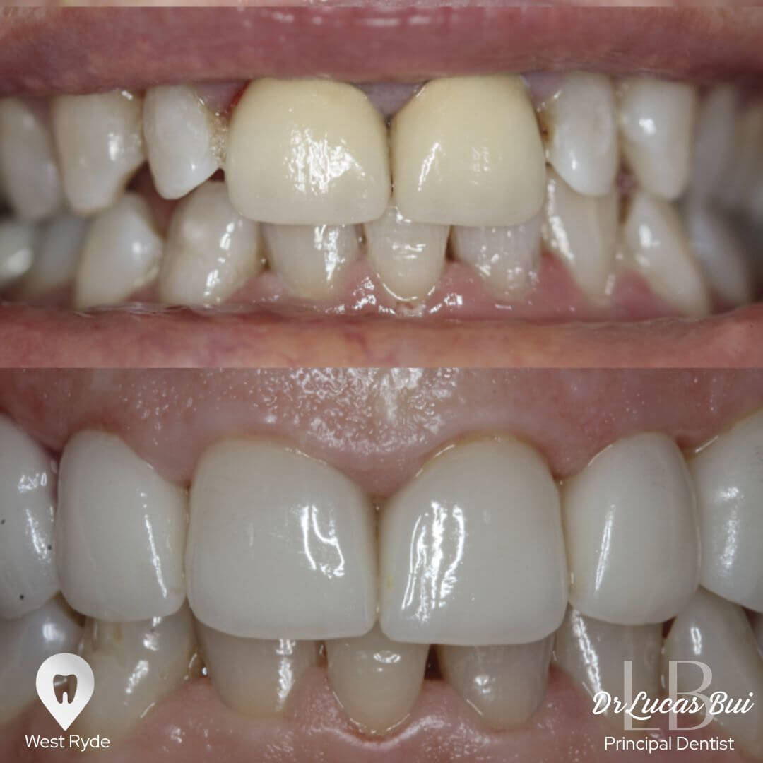 veneers