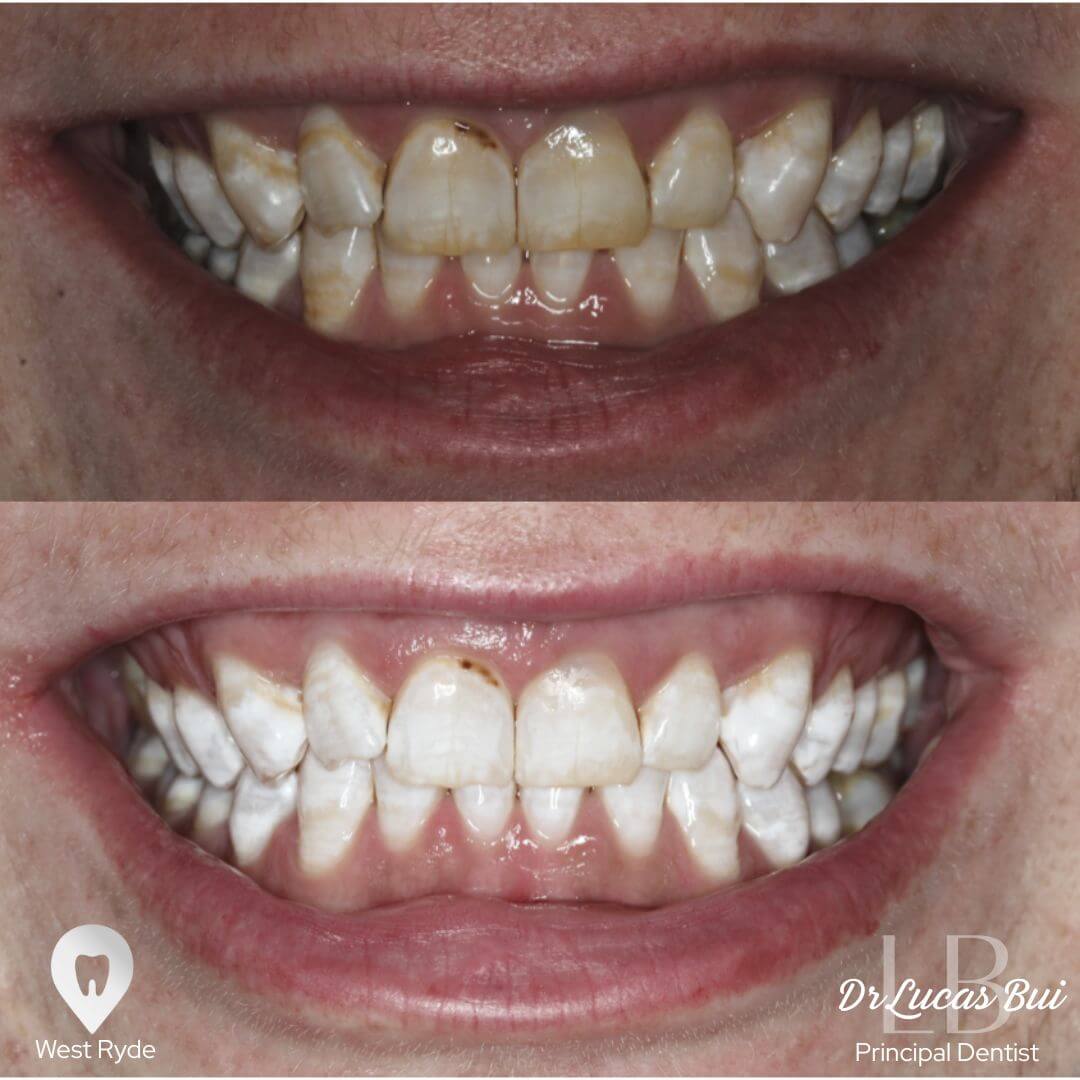 whitening