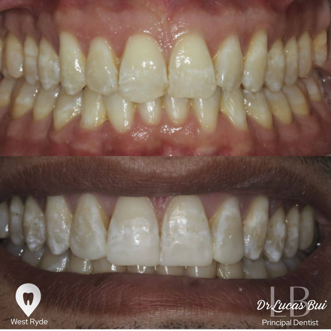 whitening1