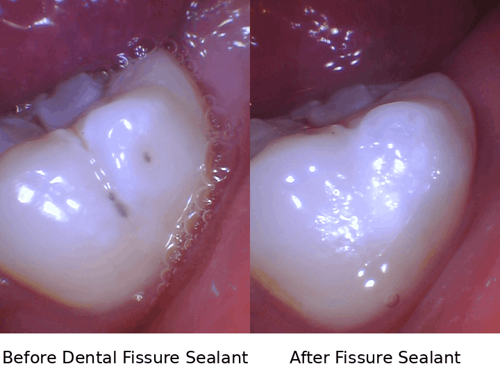 Benefits of Fissure Sealants