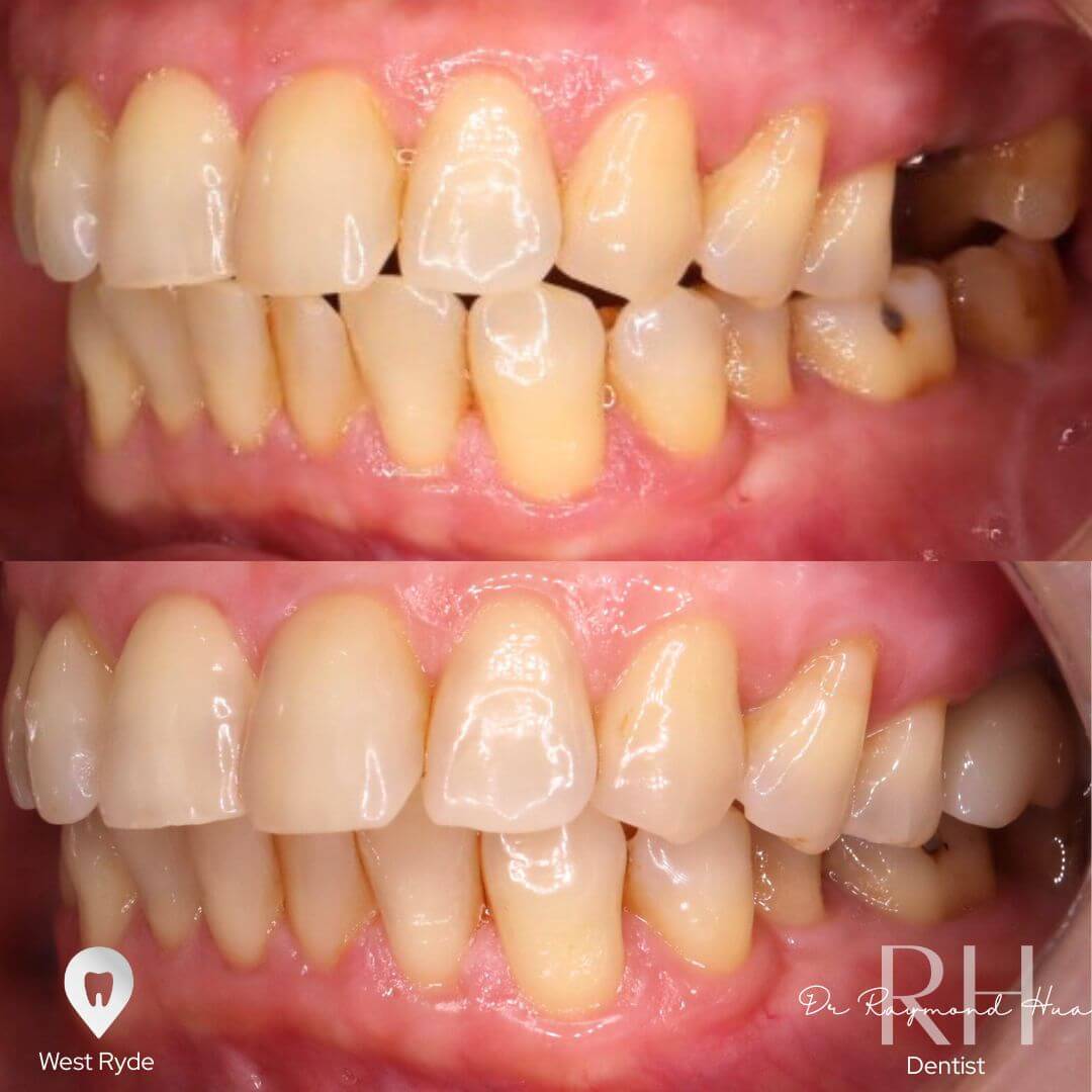 implant 2