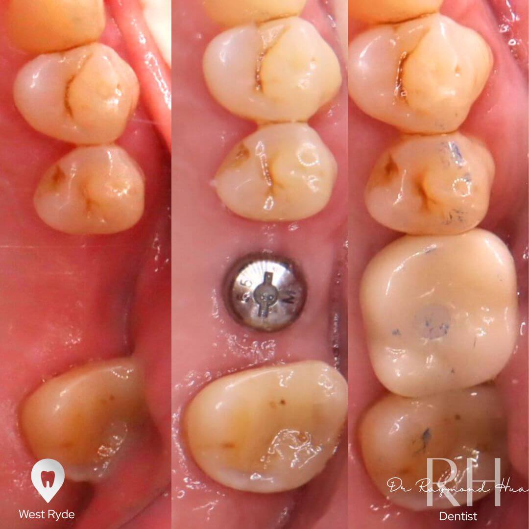 implant3