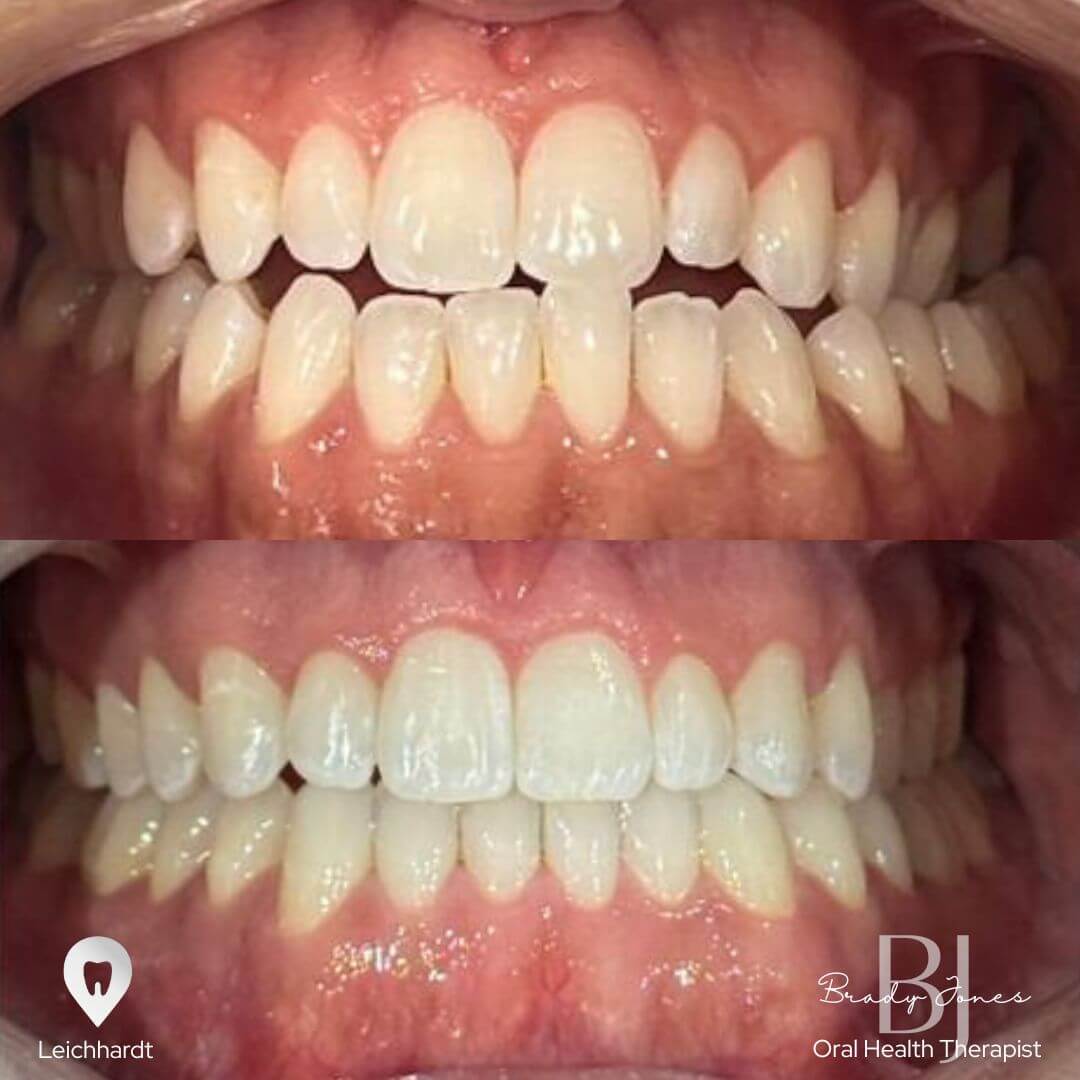 invisalign