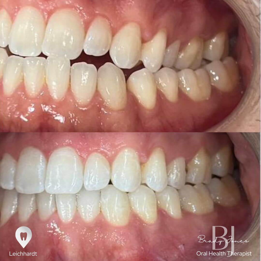 invisalign1