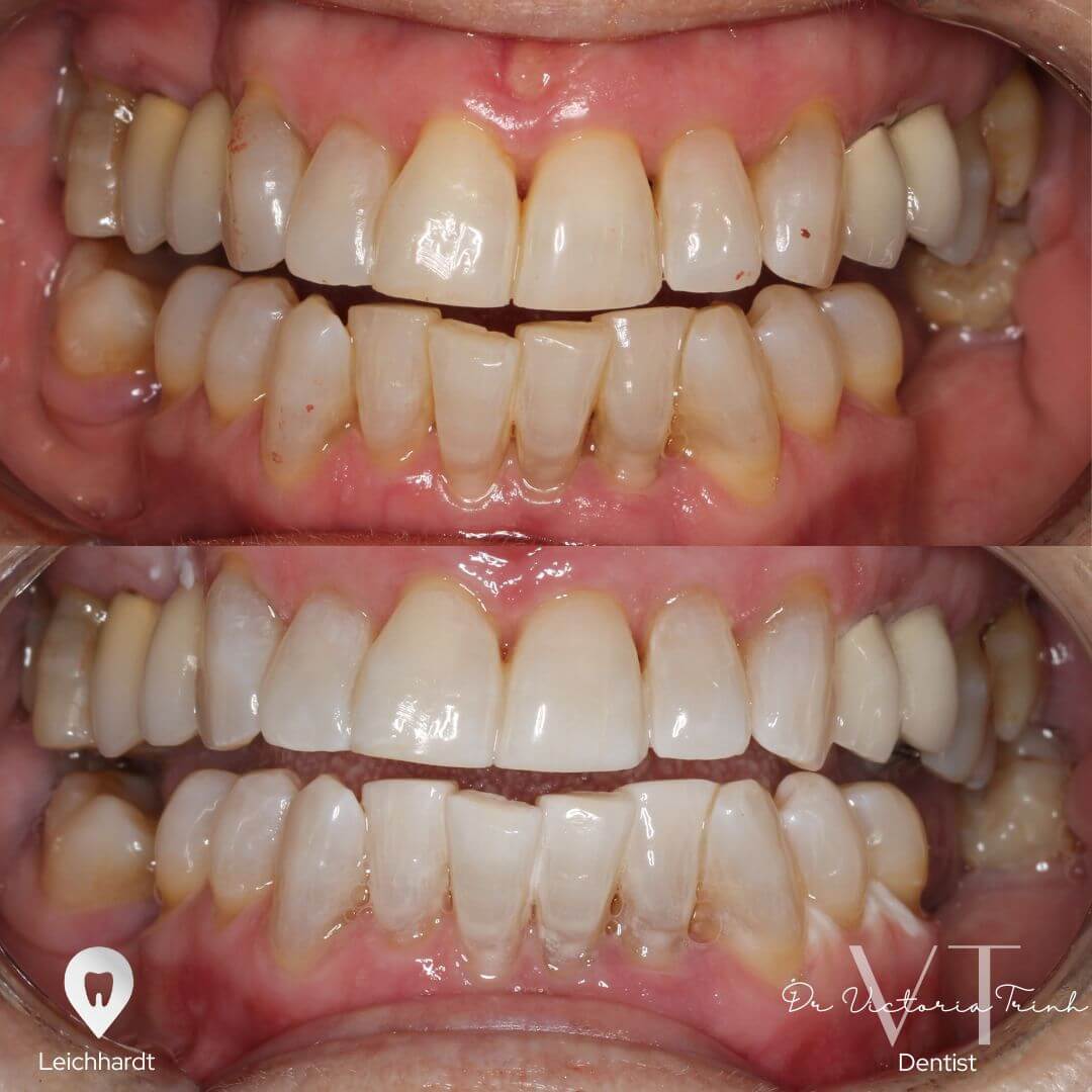 whitening 3