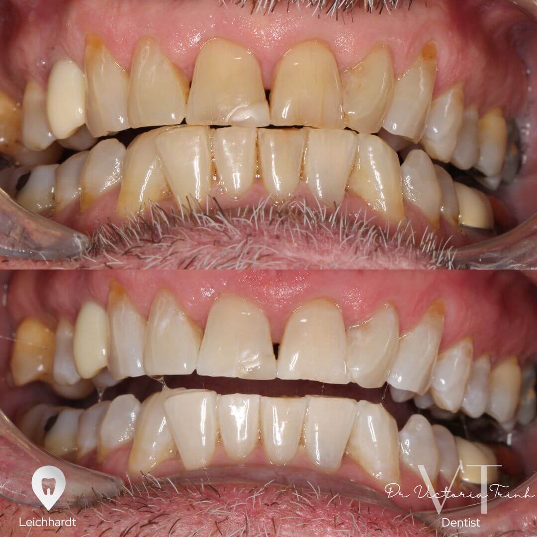whitening4