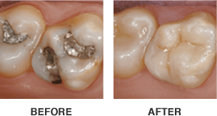 CEREC Dental Crown before and after