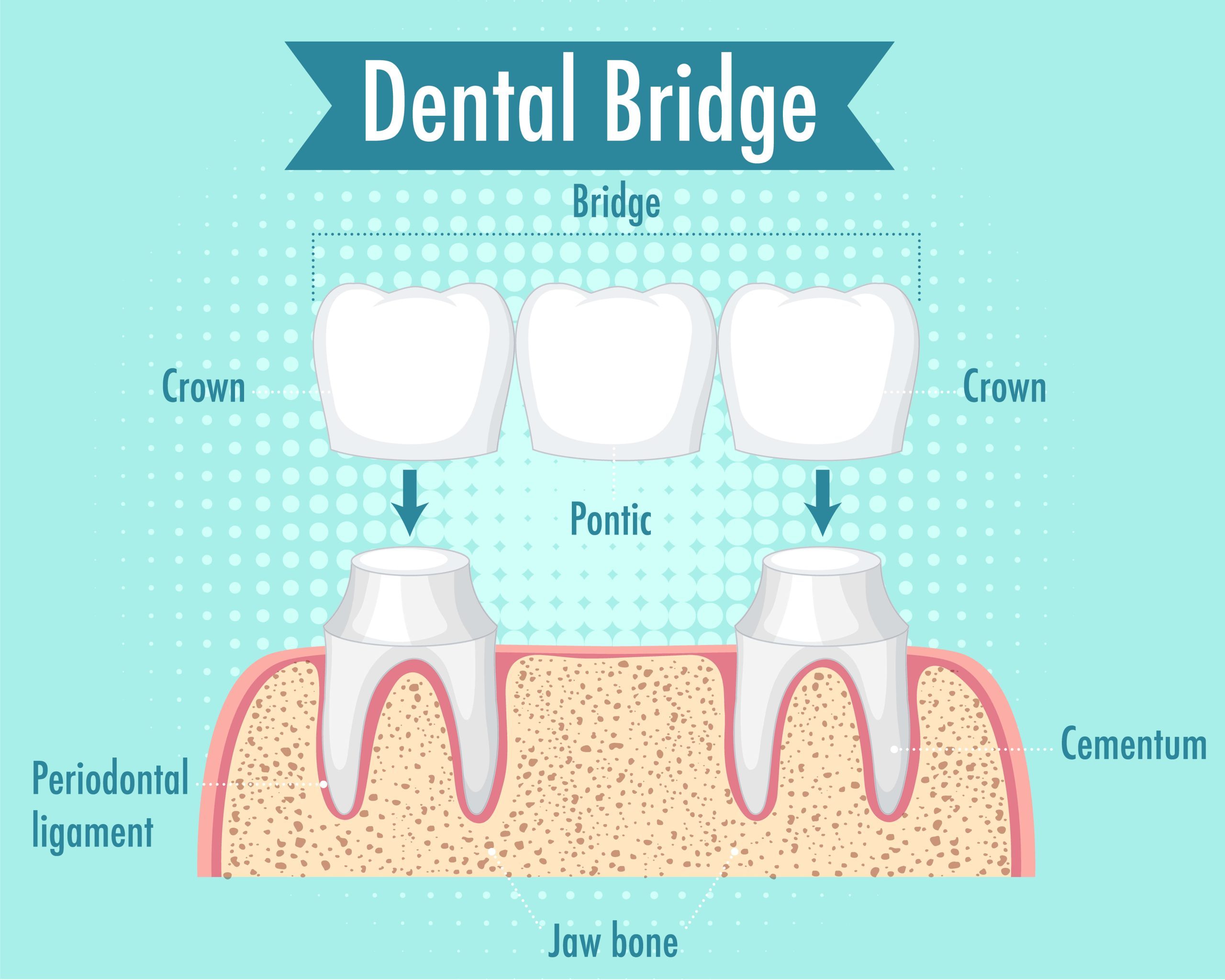 Dental Sealants Sydney scaled