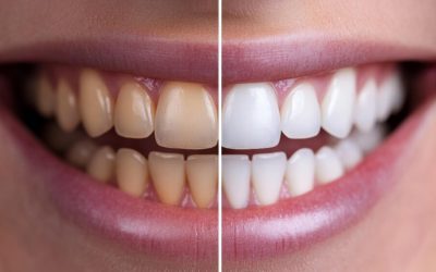How to Remove Stains From Teeth: 10 Proven Methods for a Brighter Smile